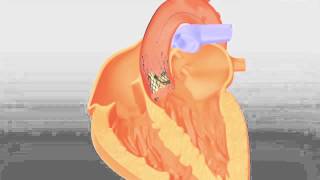 CoreValve  Transcatheter Aortic Valve Replacement by Medtronic [upl. by Atineg]