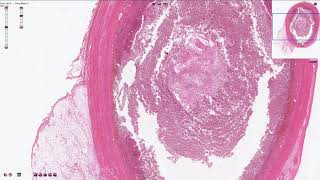 Acute Appendicitis  Histopathology [upl. by Atiseret]