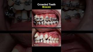 Teeth very crowded and crooked before braces orthodontist braces dentist [upl. by Aminta]