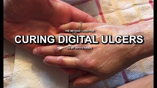 A Cure for Digital Finger Ulcers [upl. by Aiekahs274]