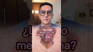 ¿Lunar o melanoma cáncer de piel Aprender a diferenciarlos medicina shorts [upl. by Magnuson357]