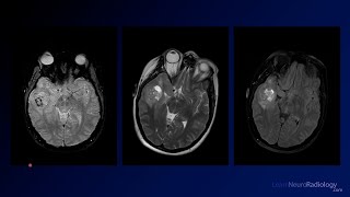 Neuroradiology Board Review  Brain Tumors  Case 7 [upl. by Adirahs]