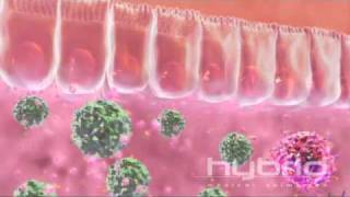 Pathology of Crohns disease [upl. by Birdt]