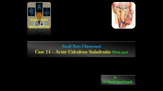 Ultrasound Case 14  Acute Calculous Sialadenitis Web case [upl. by Venetis]