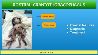 Conjoined Twins  Craniothoracophagus  Clinical features  Diagnosis  Treatment [upl. by Nosrettap585]