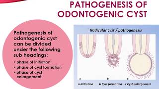 Pathogenesis of Odontogenic Cyst [upl. by Edrahc]