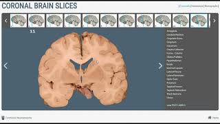 Neuroanatomy  Basal Ganglia in Brain Cross Sections [upl. by Ettie351]