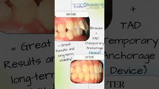 Correction of dental flaring or protrusion and a Class II bite with TADs amp braces braces sanramon [upl. by Rebma]