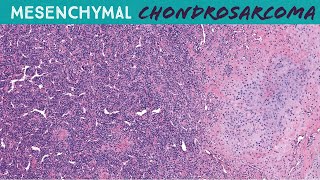 Mesenchymal Chondrosarcoma  round blue cell sarcoma with cartilage amp staghorn vessels UNC case 6 [upl. by Sinnel]