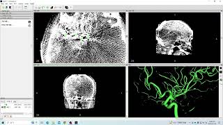 이미지DCM DICOM IMA를 STL 파일로 변환하는 방법 [upl. by Ultan]