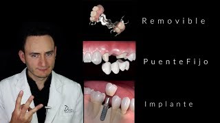 Puentes vs Implantes  ¿Cuál es la mejor opción  Dentista en Querétaro [upl. by Anigal]