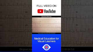 Electrical Alternans ECG shorts [upl. by Johnsson]