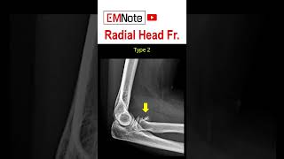 Radial Head Fracture [upl. by Ailedua188]