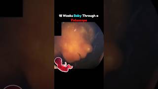 18 Weeks Baby Through Fetoscope 🤩💕 pregnancy fetus [upl. by Zaneta843]