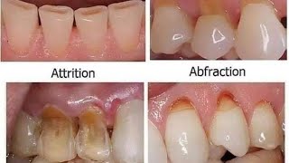 NON CARIOUS LESION  ATTRITION ABRASION EROSION [upl. by Eirena242]