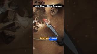 Kidney stone removal  Kidney stone treatment  laser treatment  Rirs  shorts curestone [upl. by Tyika248]