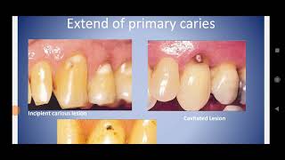 شرح carious and non carious lesions [upl. by Aileahcim]