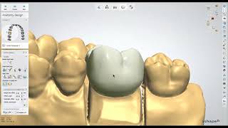 Dental Lab Life Designing a Crown in 3Shape [upl. by Agostino]