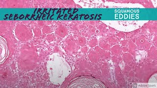 Irritated Seborrheic Keratosis squamous eddies 5Minute Pathology Pearls [upl. by Atikat901]