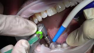 immidiate implant placement and loading [upl. by Anirda167]