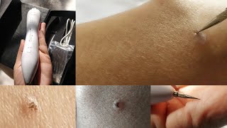 मैंने finally try किया Freckle और mole removal pen। देखिए इसे कैसे use करना है। [upl. by Theron]