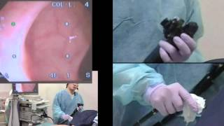 Colonoscopy  consecutive cases 120 [upl. by Okeim]