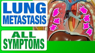 Lung Metastasis  All Symptoms [upl. by Dallman]