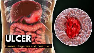 Ulcer Causes Signs and Symptoms Diagnosis and Treatment [upl. by Havelock]