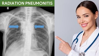 Radiation Pneumonitis [upl. by Jary]