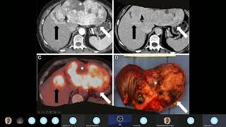 Adenomas Hepatocelulares [upl. by Ruelle]