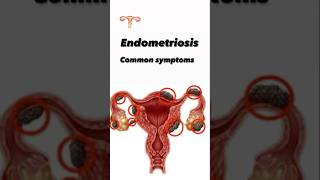 Endometriosis symptoms uterus problem womenuterine healthawarenessEndometriosis uterusproblem [upl. by Anaibib13]