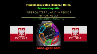 Echokardiografia  Hipokinezja DolnoBoczna I Dolna [upl. by Nnaillij800]