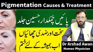 How To Treat Freckles And Pigmentation Permanently In urdu [upl. by Sesom1]