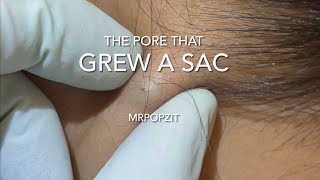 The pore that grew a sac Yellow pasty cyst pop Cyst excision on neck MrPopZit [upl. by Annoit]