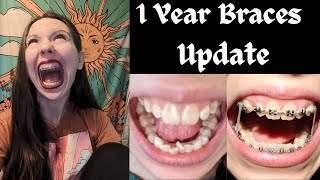 1 YEAR ADULT BRACES UPDATE🦷Progress Elastics Current Routine  More [upl. by Voorhis]