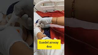 Guedel airway insertion tip and tricks The Guedel Airway A Crucial Tool in Emergency Medicine [upl. by Rorke]