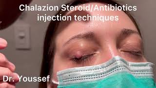 Chalazion Easiest and simplest Treatment with Steroid and Antibiotic Injections [upl. by Mallory135]