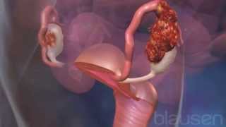 Ovarian cancer Medical animation [upl. by Shepard]