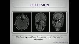 Résultats du traitement multimodal des carcinomes épidermoïdes [upl. by Hellene]