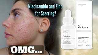 I TESTED THE ORDINARY NIACINAMIDE AND ZINC SERUM FOR MY ACNE SCARS ONE MONTH Shocked by this [upl. by Nyluqcaj]