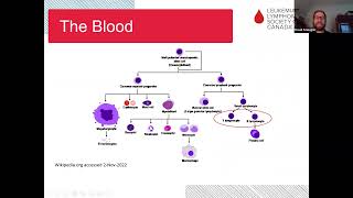 Acute lymphoblastic leukemia ALL Treatment options managing side effects and research advances [upl. by Schatz]