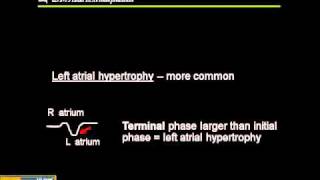 1215 Lead ECG Atrial Hypertrophy [upl. by Delmer]