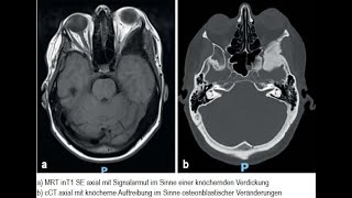 Osteodystrophia deformans Paget mit einseitigem Exophthalmus [upl. by Anissej]