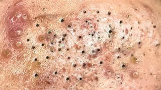 Blackhead Removal With Sac Dep Spa 1000330 [upl. by Cunningham920]