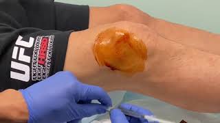 MoraMD Knee Effusion Aspiration A Nearly Painless Technique [upl. by Bohun]