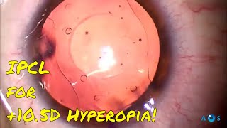 High Hyperopia Correction with IPCL Phakic Lens A StepbyStep Guide [upl. by Ynittirb]