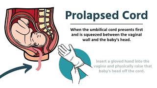 Pregnancy amp Delivery Emergencies in EMS [upl. by Ardeth]