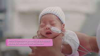 Premature baby  Nutrition and feeding [upl. by Anhcar]