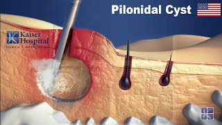 EPSiT  Endoscopic Pilonidal Sinus Treatment [upl. by Yerffeg]