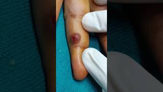 Pyogenic Granuloma treatment dermatologist skintreatment pyogenicGranuloma minivlog shortvideo [upl. by Rodolph963]